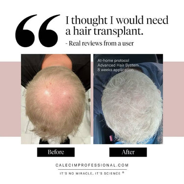 No need for a hair transplant use CALECIM Pro Advanced Hair System